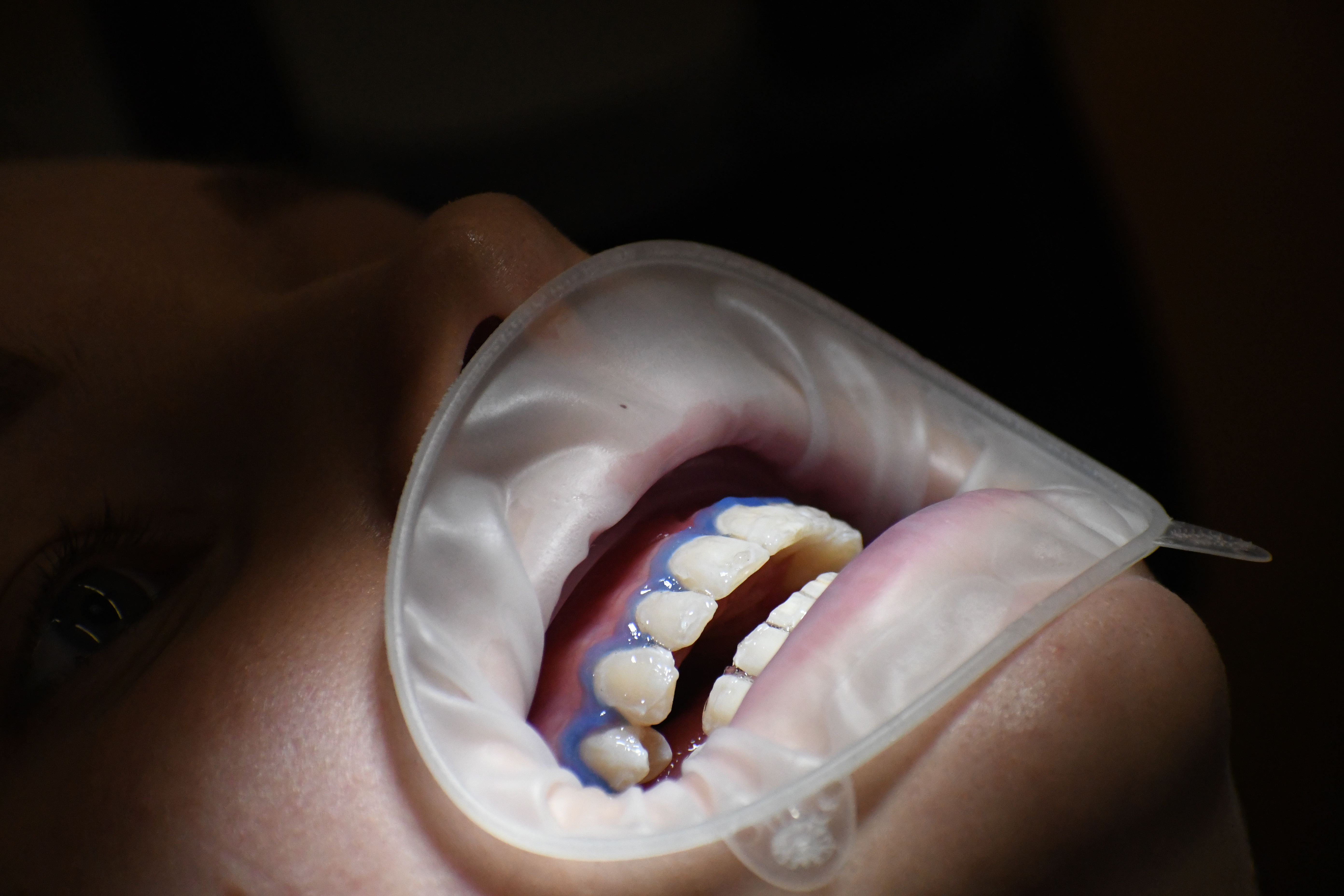 Die innovativen Zahnaufhellungslösungen von Cavex